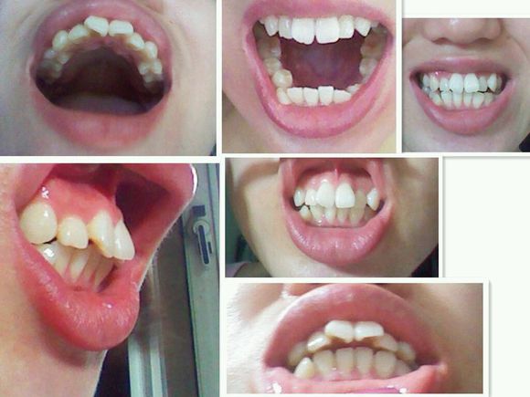 骨性龅牙和牙性龅牙有什么不同