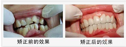 西安成年人做牙齿矫正困不困难