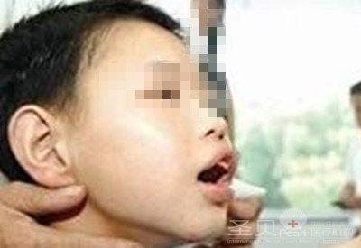 圣贝儿童骨性错颌矫正案例 