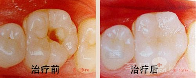成年人蛀牙的治疗方法有哪些